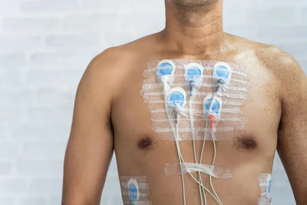 Holter Monitoring