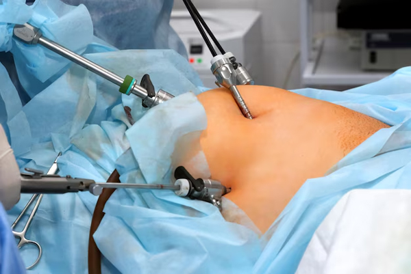Laparoscopic Surgery